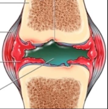 a lábfejes ízületek ízületi gyulladása térdfájdalom az életkorral