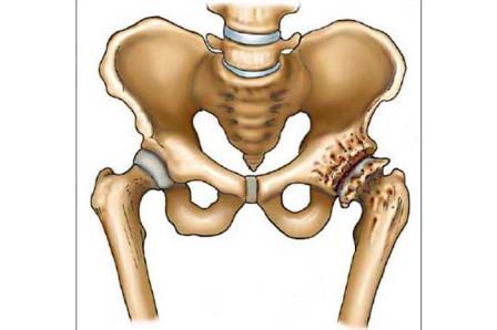 A csípőízület kopása - Okok és tünetek - A csípőízület 1. fokozatú kezelési tünetei
