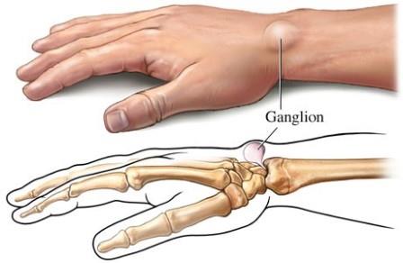 a hüvelykujj kezének kezelése illóolaj ízületi betegségek kezelésére