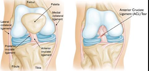 Csípőízületi artrózis