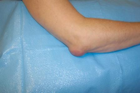 A ganglion - Dudor kialakulása az ízületeknél Fájó láb az ízület alján