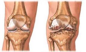 hogyan lehet kezelni az ízület lábának artrózisát)
