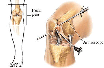 Artroszkópos térdműtét A térd meniszkuszának posztoperatív kezelése