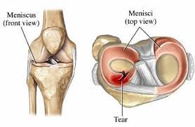 meniscus szakadás műtét nélkül