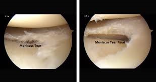 meniscus szakadás műtét nélkül