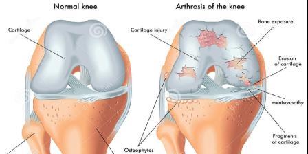 térdízületi fajok artrózisa fájdalmat okoznak a lábak ízületeiben
