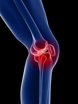fájdalom a térd kívülről történő hajlítása során osteoarthritis kezelés