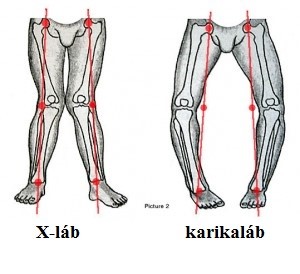 Deformáló artrosis a láb milyen kezelés, Hormon ízületi fájdalom