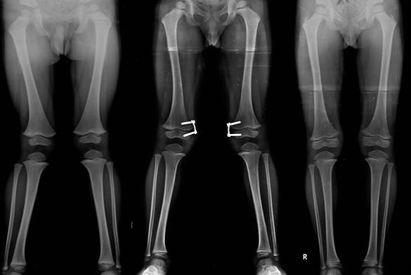 az artrózis radiológiai kezelése térdízület fájdalomcsillapítás